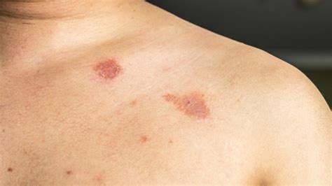 Got Ringworm? We’ve Got the Causes, Symptoms and Remedies – The Amino Company