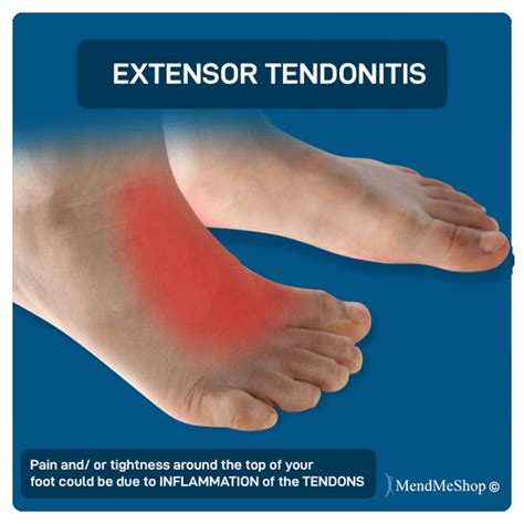 Tendonitis Foot Sale | cityofclovis.org