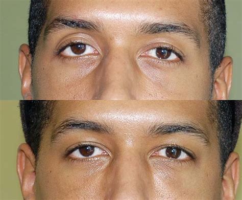 Transconjunctival fat transfer – OZ Cosmetic Clinic