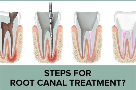 Root Canal Treatment in Scottsdale & Avondale AZ - Mod Dentistry