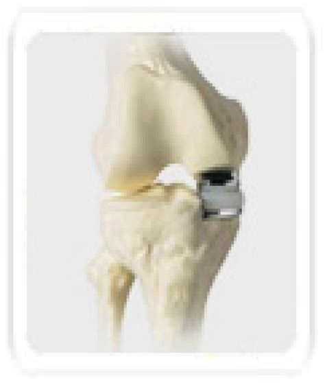 Unicondylar Knee Replacement Surgery in Powai, Mumbai, Dr. Sanjeev Jain | ID: 6325420755