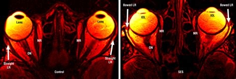 Sagging Eye SyndromeConnective Tissue Involution as a Cause of Horizontal and Vertical ...