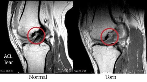 Right Knee Acl Tear Mri / The ABCs of Al Harrington's Torn ACL | Golden ...