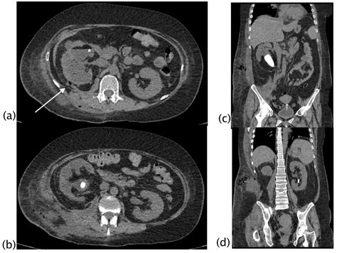 Xanthogranulomatous Pyelonephritis Ultrasound