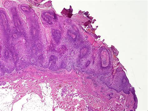 Bowen's disease - wikidoc