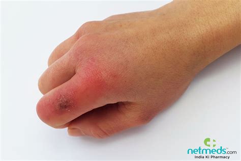 Chilblains: Causes, Symptoms And Treatment