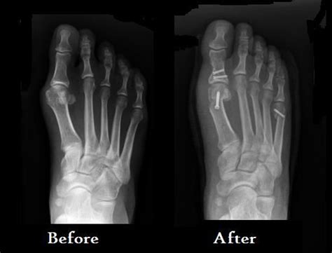 1000+ images about Bunion surgery on Pinterest | Before and after ...