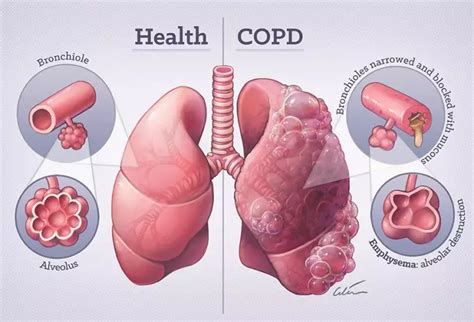 Understanding COPD: Symptoms, Causes, Diagnosis, Treatment, and Living ...