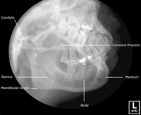 Mandible Radiographic Anatomy - wikiRadiography | Radiology, Facial bones, Radiology student