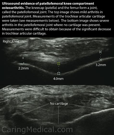 Patellofemoral osteoarthritis (Knee cap arthritis)