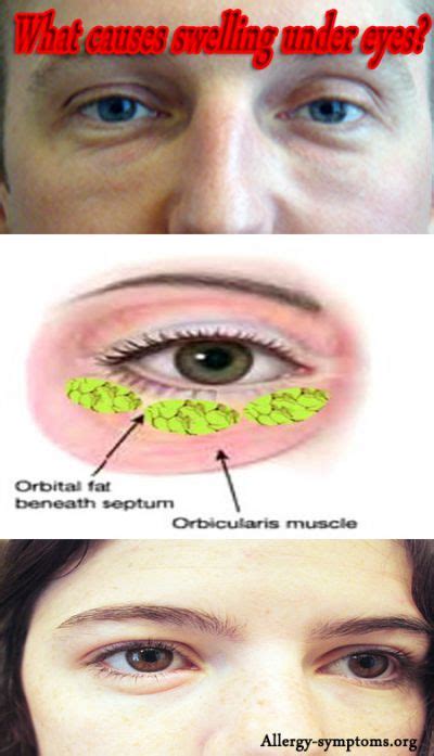 Periorbital Edema Causes and Treatment - Allergy-symptoms.org