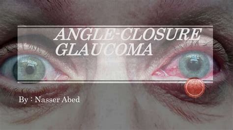 angle closure glaucoma.pptx