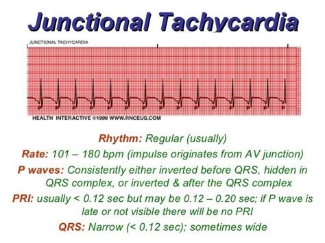 junctional tachycardia,what to know?