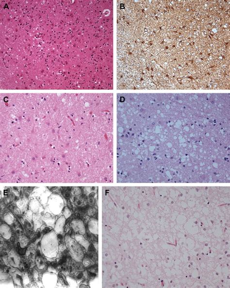 Prion Protein Disease and Neuropathology of Prion Disease | Radiology Key