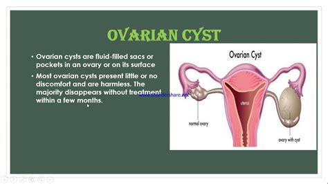 Para-tubal Cyst & Ovarian Cyst - YouTube