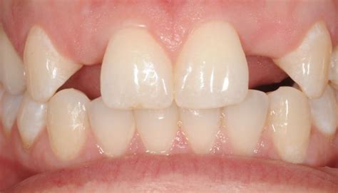 Congenitally Missing Teeth: Causes and Treatments | New Health Advisor