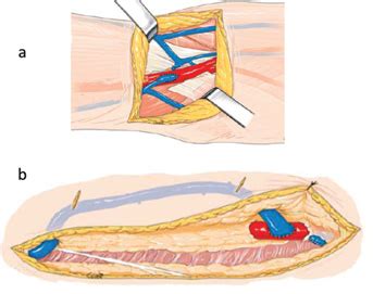 -Two-stage superficial tunnel-transposition of the basilic vein in the... | Download Scientific ...