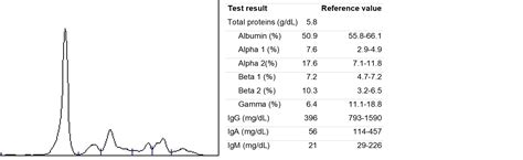 Kappa Light Chain Multiple Myeloma Prognosis | Shelly Lighting