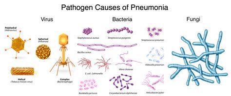 pathogen-causes-of-pneumonia - Pediatric Pulmonologists