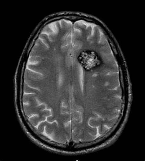 MRI appearance of a Cerebral Cavernous Malformation. Axial T2 FSE MRI ...