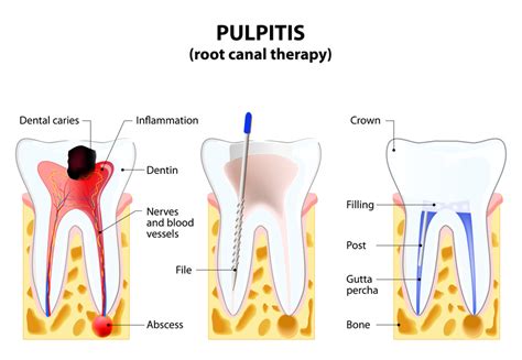 Recognize the symptoms of failed root canal - Smile Angels of Beverly Hills