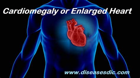 Cardiomegaly – Causes, Complications and Prevention.