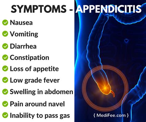 Appendicitis Anatomy