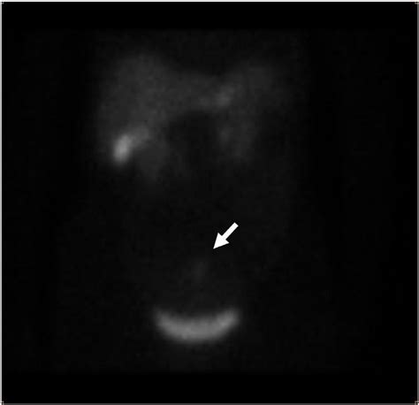 -Octreotide scan objectiving uptake of the radiotracer at the level of ...