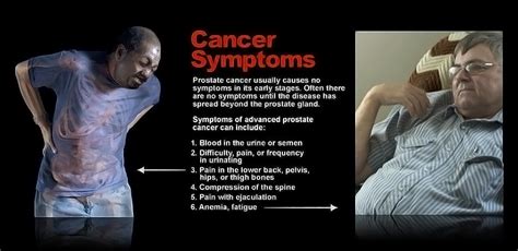 Symptoms of Advanced Prostate Cancer - StoryMD