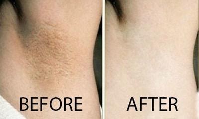 Underarm Whitening Treatment | Wellness Today