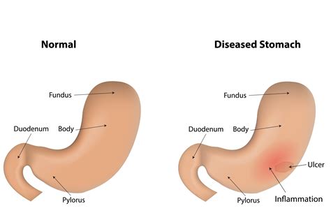 Gastritis - Jackson Siegelbaum Gastroenterology