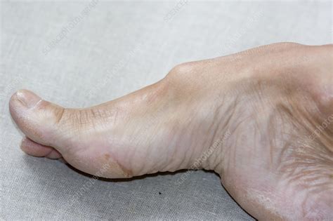 High arched foot - Stock Image - C002/7464 - Science Photo Library