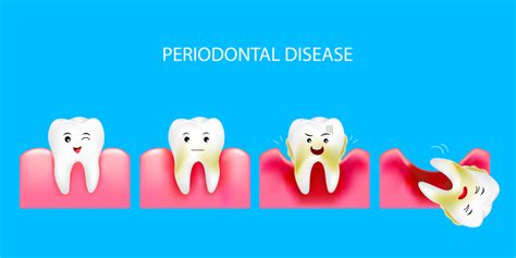 How to Prevent Gum Disease