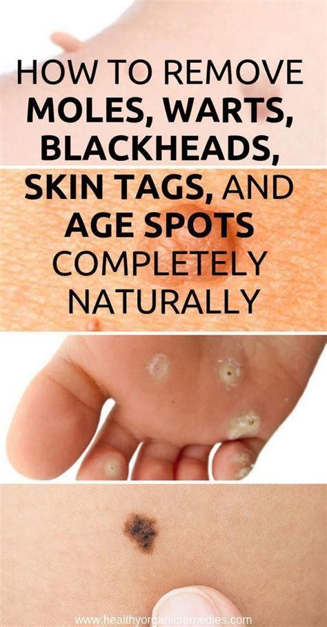 Type of Skin Moles - Healthy Medicine Tips in 2020 | Skin moles, Mole removal, Moles on face