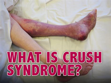 What Happens In Crush Syndrome? Know About Its Causes, Symptoms ...