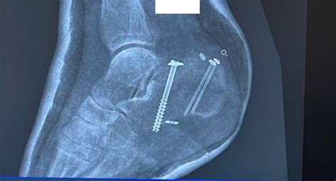 Tongue-Type Calcaneal Fracture Image 7 XR Unannotated - JETem