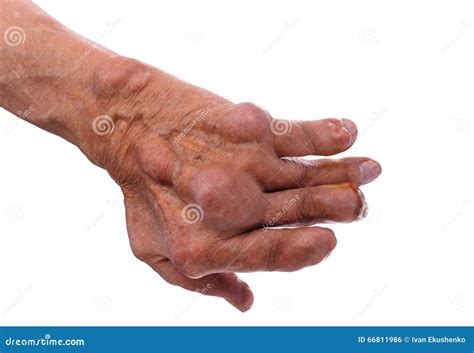 Man with a Diagnosis of Polyarthritis. Stock Photo - Image of joint ...