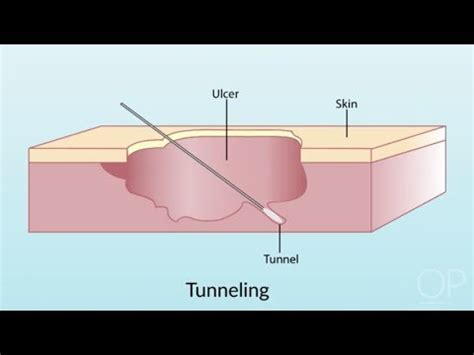 tunneling wound vs undermining - Caption Simple