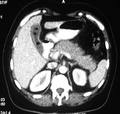 Radiodiagnosis - Imaging is Amazing-Interesting cases: Cholesterol ...