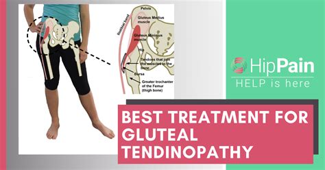 Best Treatment For Gluteal Tendinopathy/Trochanteric, 44% OFF