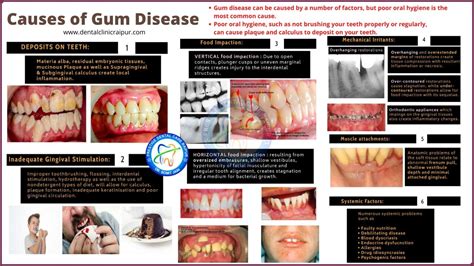 Periodontitis & Gingivitis Meaning Symptoms Tx | Gum Disease