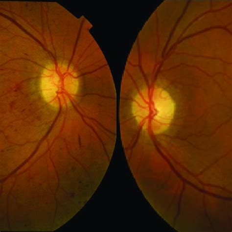 (PDF) Sindrome de isquemia Ocular. Revision