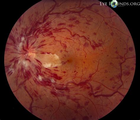 What to Know About a Flame Hemorrhage | Contacts Compare