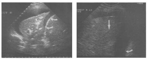 (a) Air bronchogram: the air within the bronchi is echogenic and ...