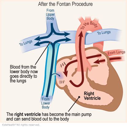 The Fontan Procedure (for Parents) - Humana - Louisiana