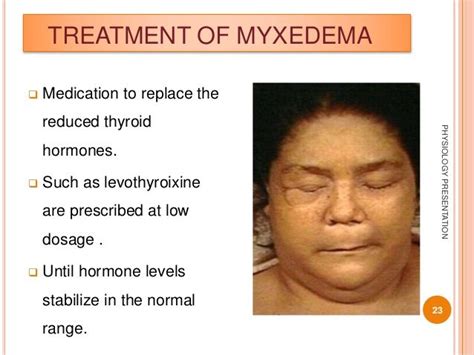 myxedema | Thyroid disease symptoms, Thyroid disease, Thyroid problems