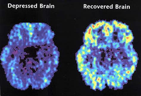 PET scan pictures - Major Depressive Disorder