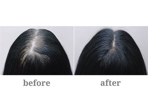 Biotin Hair Growth: Before And After Results (With, 55% OFF