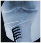 High Tibial Osteotomy Surgery,High Tibial Osteotomy Knee Surgery India