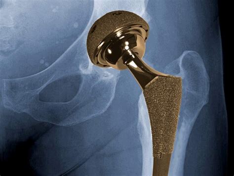 NIH researchers uncover clues related to metal-on-metal hip implants ...